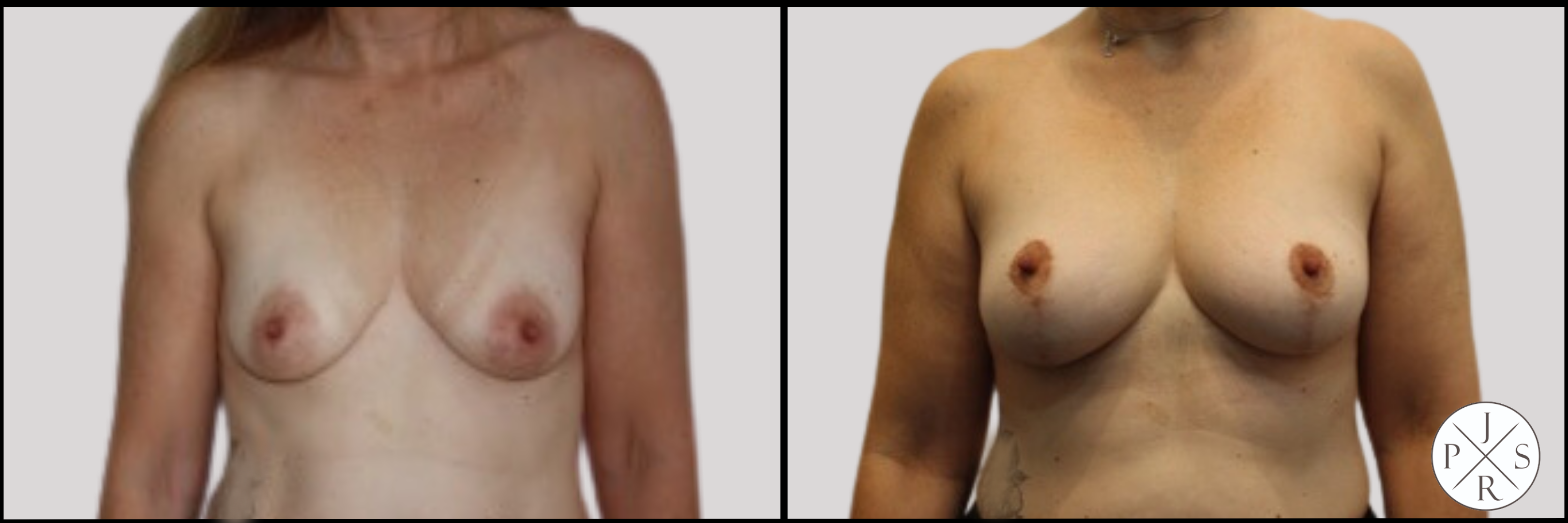 Fat Transfer Breast Augmentation Before & After Image